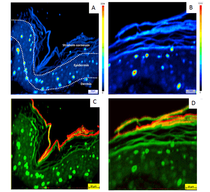 Uranium contamination in skin